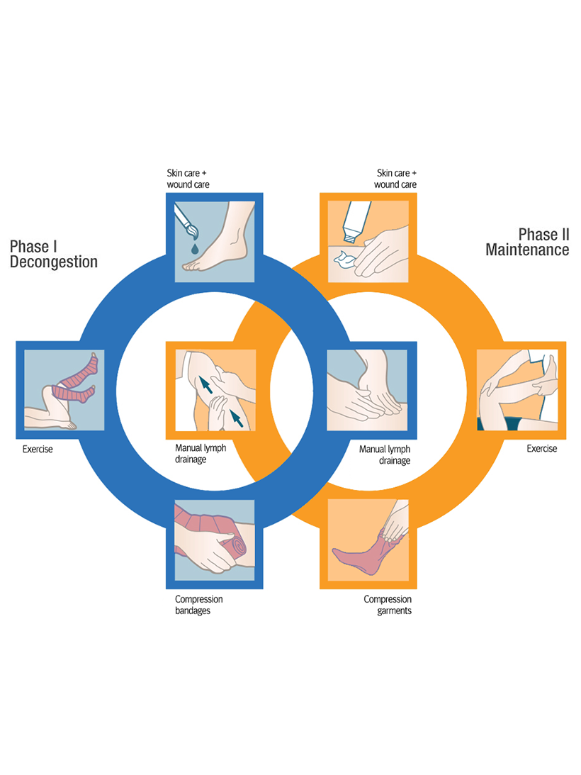 Treatment of Lymphedema